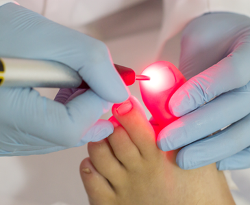 Fototerapia/soft laser - Goiânia e Aparecida - Crispé Podologia.